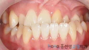 원본 비대칭교정 치료 전