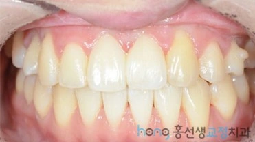 원본 비대칭교정 치료 후