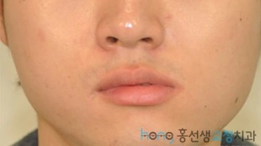원본 비대칭교정 치료 전
