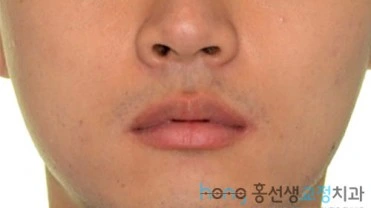 원본 비대칭교정 치료 후