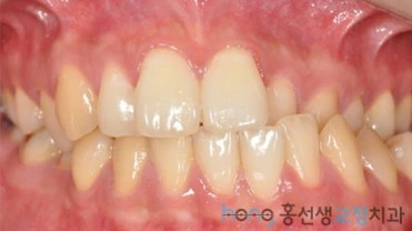 원본 비대칭교정 치료 전