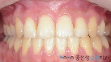 원본 비대칭교정 치료 후