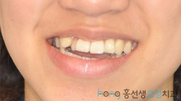 원본 비대칭교정 치료 전