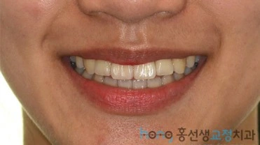 원본 비대칭교정 치료 후