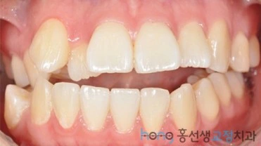 원본 비대칭교정 치료 전