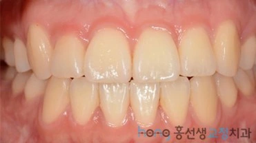 원본 비대칭교정 치료 후
