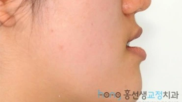 원본 주걱턱교정 치료 전