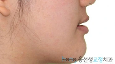 원본 주걱턱교정 치료 후