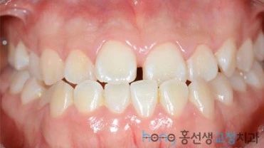원본 주걱턱교정 치료 전