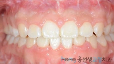 원본 주걱턱교정 치료 후