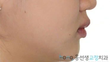 원본 주걱턱교정 치료 후