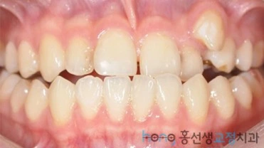 원본 주걱턱교정 치료 전