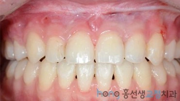 원본 주걱턱교정 치료 후