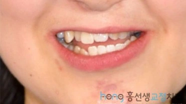 원본 비대칭교정 치료 전