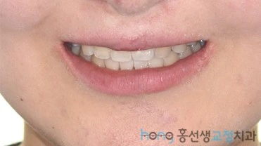 원본 비대칭교정 치료 후