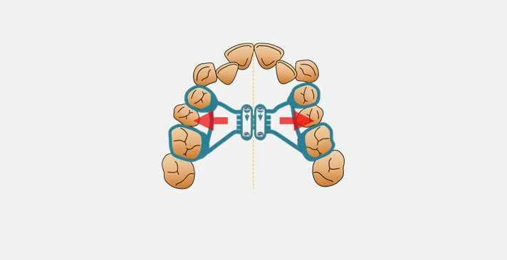 위턱 확장 장치의 힘 방향을 보여 주는 원본 모식도