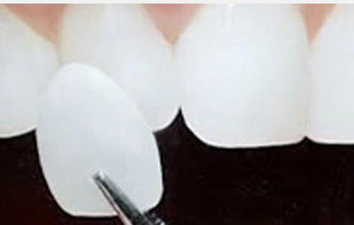 치아 앞면에 맞추는 얇은 보철물의 설명 사진