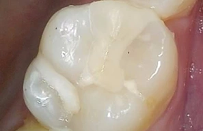 기존 증례의 수복 후 사진