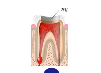 치아 안쪽으로 접근하는 신경치료 설명 그림