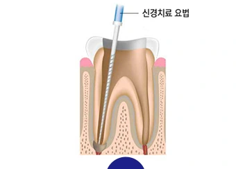 치아 안쪽 조직을 제거하는 설명 그림