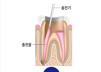 뿌리 내부를 정리하고 충전하는 설명 그림
