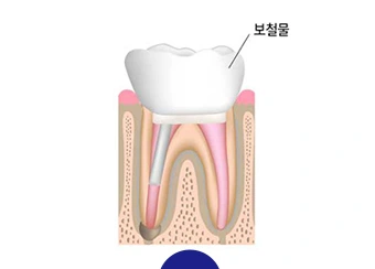 수복물로 치아를 보호하는 설명 그림