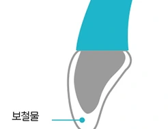 치아 전체를 감싸는 크라운의 단면 설명 그림