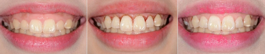 기존 홈페이지의 잇몸성형 전·직후·회복 후 기록
